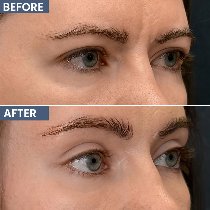 ROVINAO® Lid Lifting Treatment