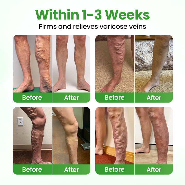 Tenviro® VeinHeal Microneedle Patch