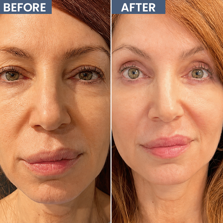 ROVINAO® Lid Lifting Treatment