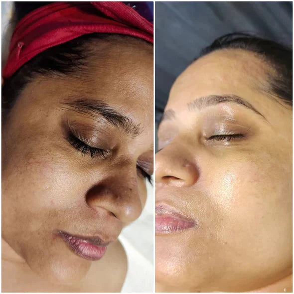 ✨Fast Dark Spot Remover-Lummvra™  Melanin Correcting Facial Serum(🔥Last Day Promotion 60% OFF)