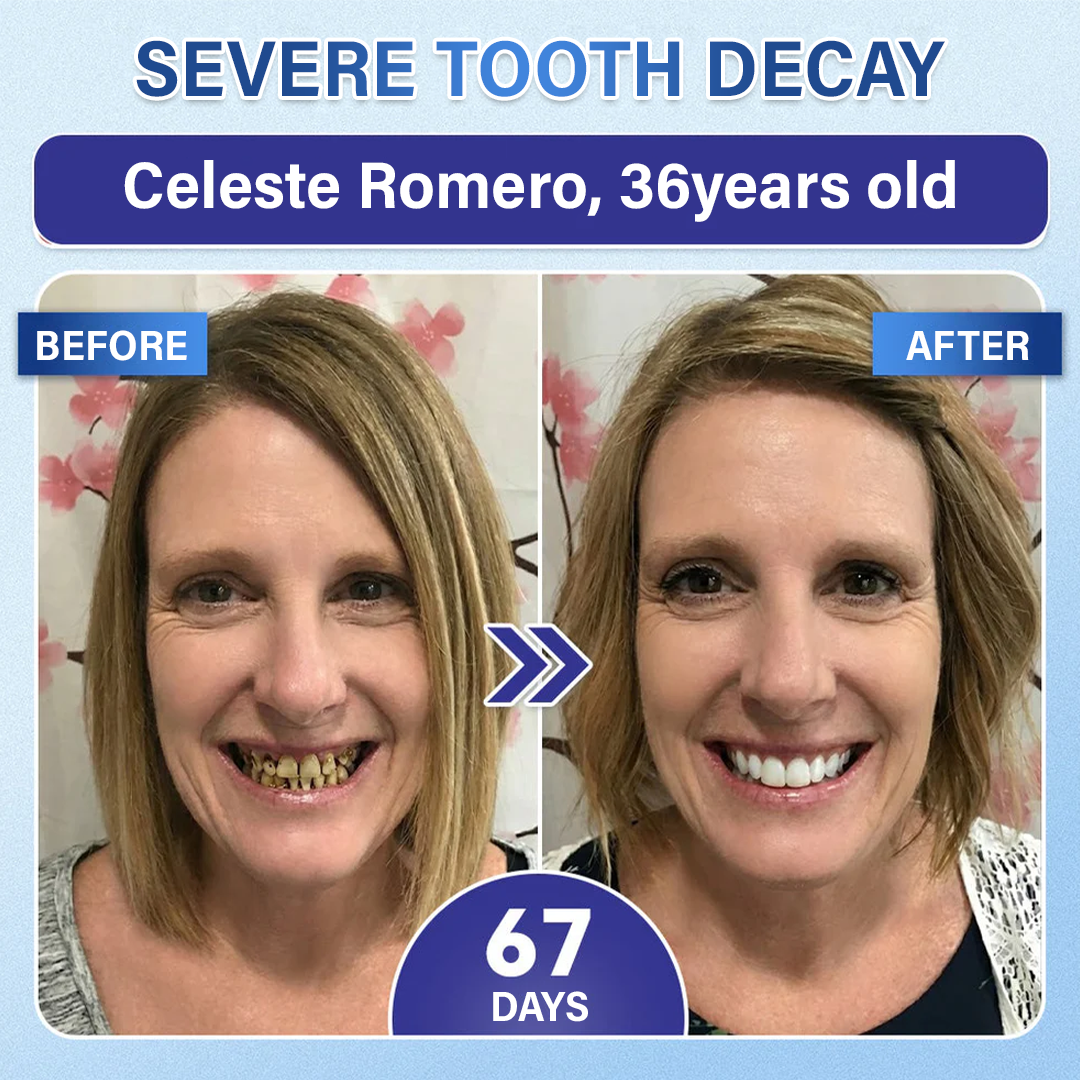 Your Smile🦷Ceoerty® Tooth & Gum Repair Fast-Dissolving Microneedle Patch✨ (𝟓-𝐢𝐧-𝟏 💎 𝐑𝐞𝐛𝐮𝐢𝐥𝐝 𝐄𝐧𝐚𝐦𝐞𝐥 & 𝐃𝐞𝐧𝐭𝐢𝐧 • 𝐒𝐭𝐫𝐞𝐧𝐠𝐭𝐡𝐞𝐧 𝐆𝐮𝐦𝐬 • 𝐄𝐫𝐚𝐝𝐢𝐜𝐚𝐭𝐞 𝐓𝐚𝐫𝐭𝐚𝐫 & 𝐎𝐝𝐨𝐫 • 𝐖𝐡𝐢𝐭𝐞𝐧𝐢𝐧𝐠 • 𝐒𝐭𝐨𝐩 𝐓𝐨𝐨𝐭𝐡 𝐒𝐞𝐧𝐬𝐢𝐭𝐢𝐯𝐢𝐭𝐲)🔥