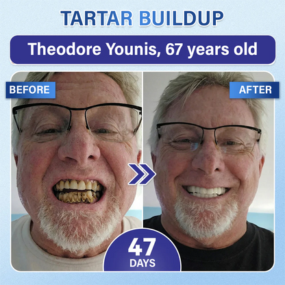 Your Smile🦷Ceoerty® Tooth & Gum Repair Fast-Dissolving Microneedle Patch✨ (𝟓-𝐢𝐧-𝟏 💎 𝐑𝐞𝐛𝐮𝐢𝐥𝐝 𝐄𝐧𝐚𝐦𝐞𝐥 & 𝐃𝐞𝐧𝐭𝐢𝐧 • 𝐒𝐭𝐫𝐞𝐧𝐠𝐭𝐡𝐞𝐧 𝐆𝐮𝐦𝐬 • 𝐄𝐫𝐚𝐝𝐢𝐜𝐚𝐭𝐞 𝐓𝐚𝐫𝐭𝐚𝐫 & 𝐎𝐝𝐨𝐫 • 𝐖𝐡𝐢𝐭𝐞𝐧𝐢𝐧𝐠 • 𝐒𝐭𝐨𝐩 𝐓𝐨𝐨𝐭𝐡 𝐒𝐞𝐧𝐬𝐢𝐭𝐢𝐯𝐢𝐭𝐲)🔥