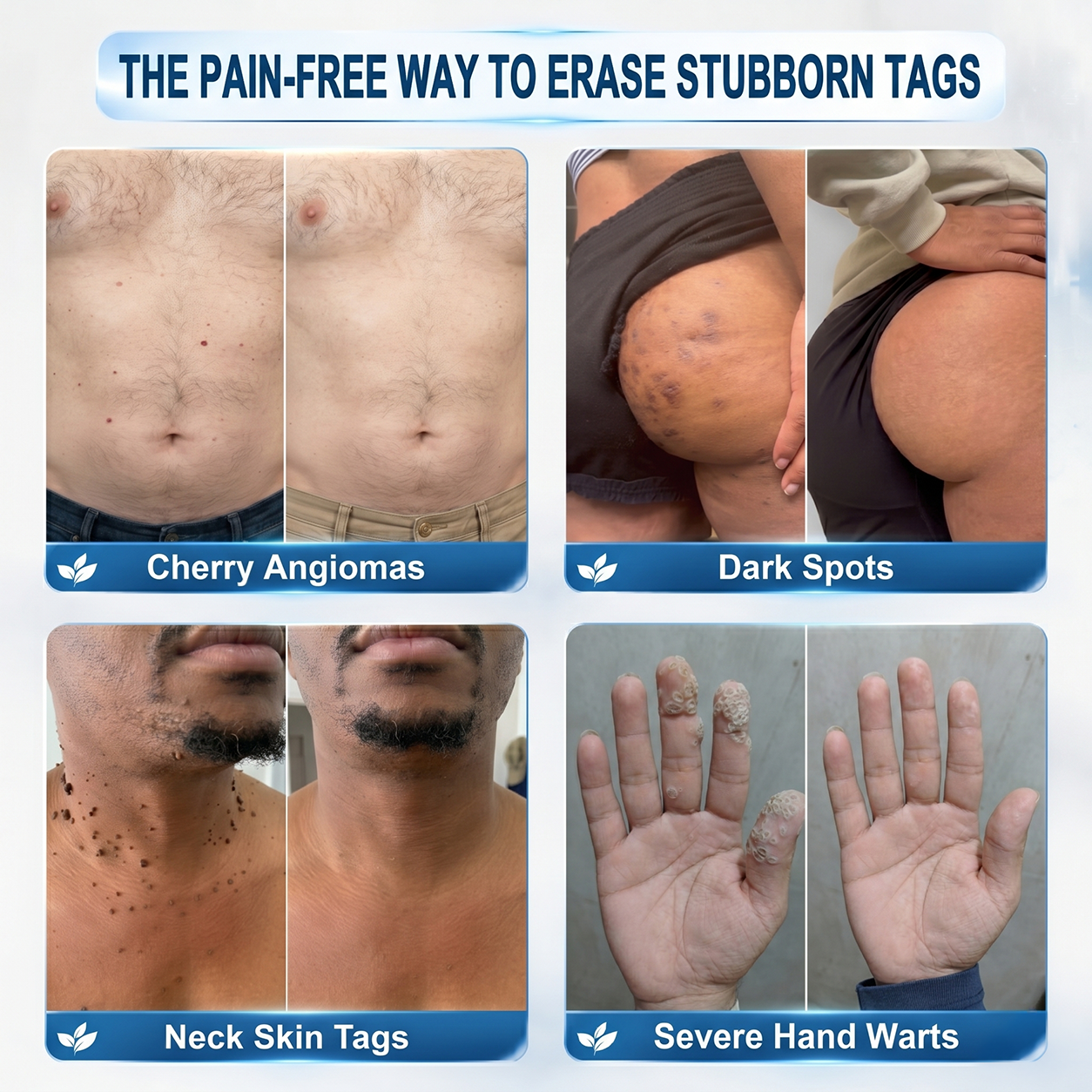 Official Store🎉7-𝐷𝑎𝑦 𝗧𝐚𝐠 & 𝗦𝗽𝐨𝐭 𝐄𝐫𝒂𝒔𝒆𝒓(Zero Pain, Zero 𝐒𝐜𝐚𝒓𝒔 Rollerball)