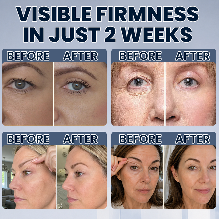 ROVINAO® Lid Lifting Treatment