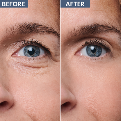 ROVINAO® Lid Lifting Treatment