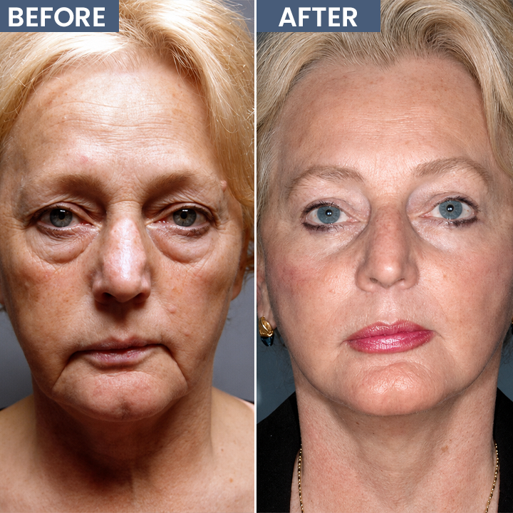 ROVINAO® Lid Lifting Treatment