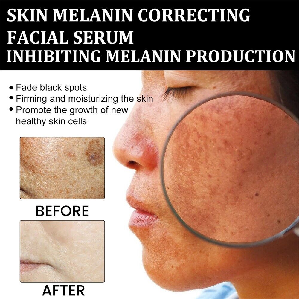 ✨Fast Dark Spot Remover-Lummvra™  Melanin Correcting Facial Serum(🔥Last Day Promotion 60% OFF)
