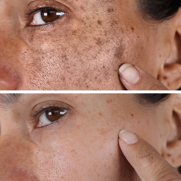 ✨Fast Dark Spot Remover-Lummvra™  Melanin Correcting Facial Serum(🔥Last Day Promotion 60% OFF)