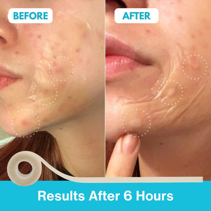 ROVINAO Hydrocolloid Roll