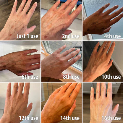 ✨Fast Dark Spot Remover-Lummvra™  Melanin Correcting Facial Serum(🔥Last Day Promotion 60% OFF)